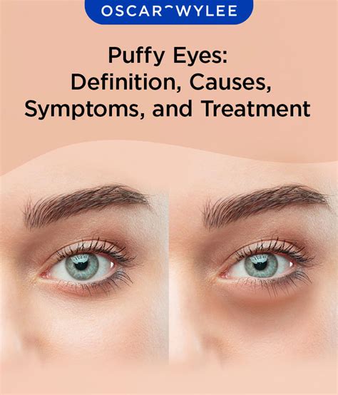 Bates referred to often was lying. . Spiritual meaning of puffy eyes
